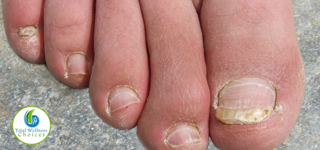 Essential Oil Good Toenail Fungus