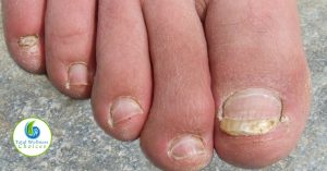 Essential Oil Good Toenail Fungus