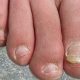 Essential Oil Good Toenail Fungus