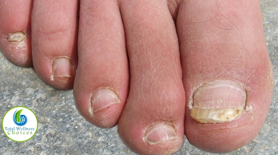 Essential Oil Good Toenail Fungus