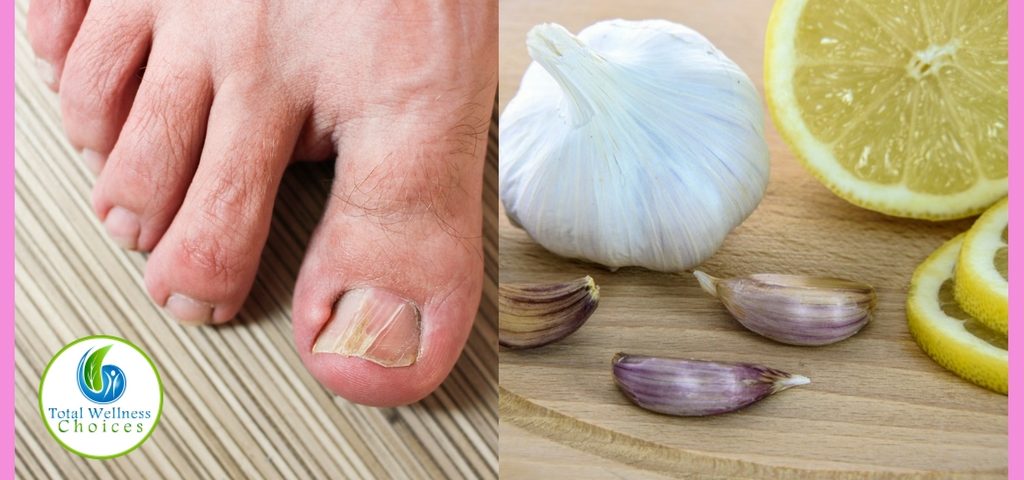 Natural Remedies for Nail Fungus