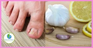 Natural Remedies for Nail Fungus