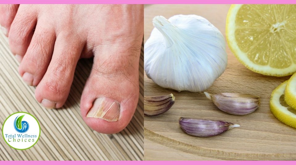 Natural Remedies for Nail Fungus