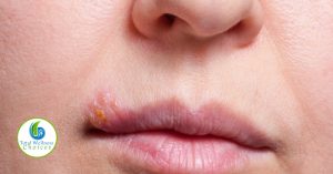 Home remedies fever blisters lips