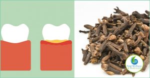 Use Clove Oil Tooth Pain