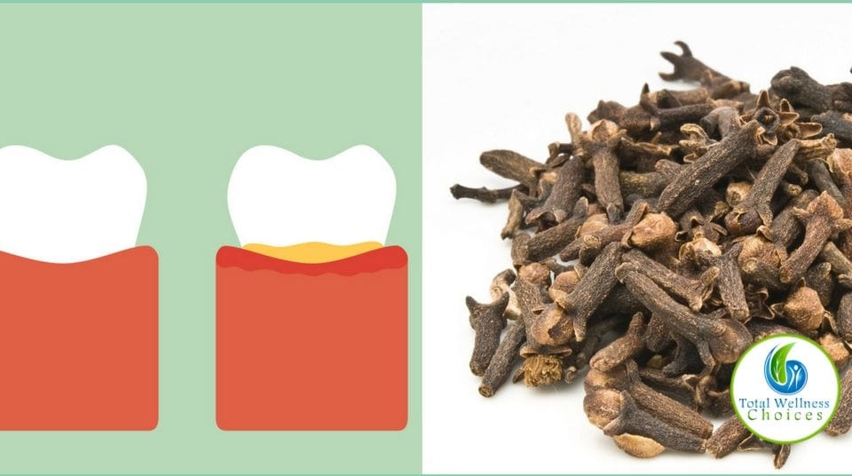 Use Clove Oil Tooth Pain