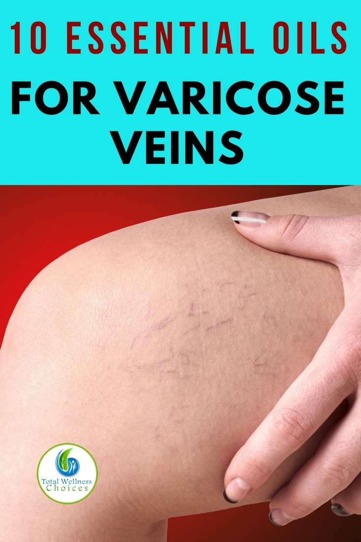 Essential Oil Good Varicose Veins