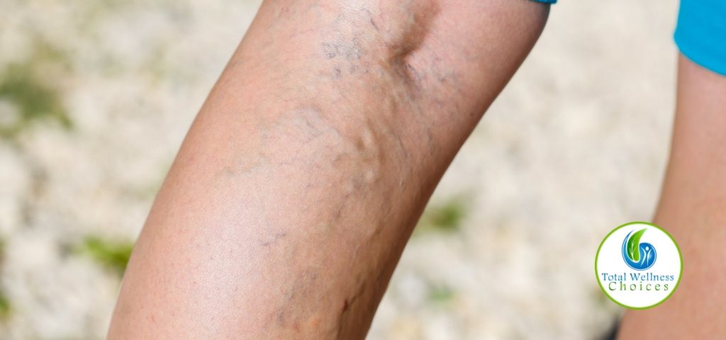 Essential Oils Varicose Veins