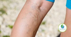 Essential Oils Varicose Veins