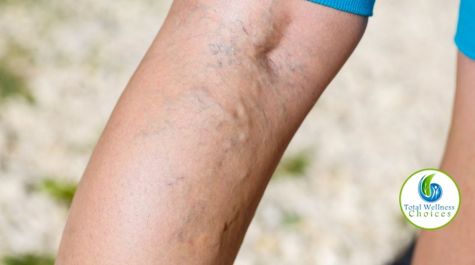 Essential Oils Varicose Veins