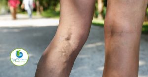 Natural Way Get Rid Varicose Veins