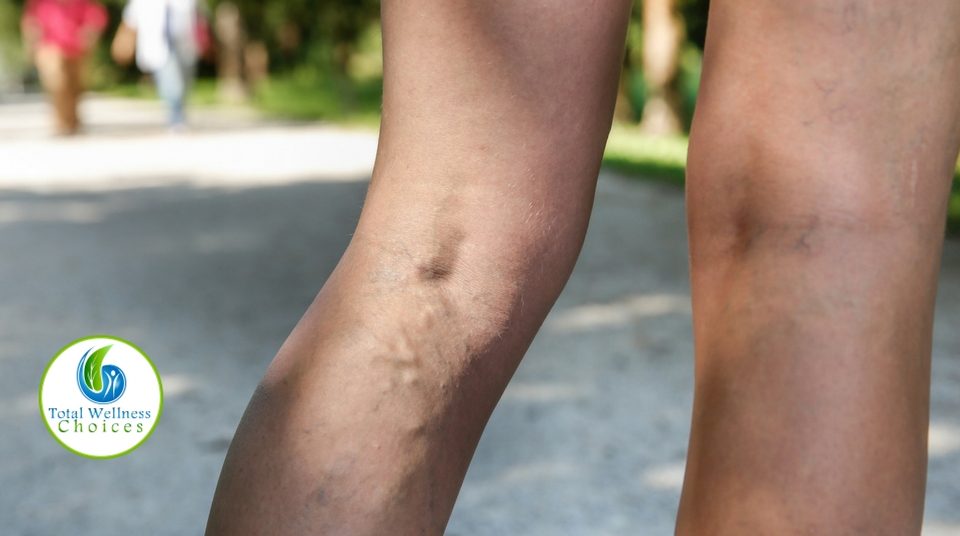 Natural Way Get Rid Varicose Veins