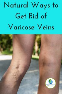 Natural Ways to Get Rid of Varicose Veins