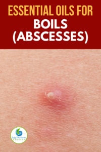 Best Essential Oils for Boils (Abscesses)