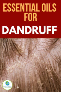 Best essential oils for dandruff and itchy scalp