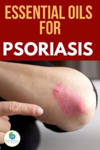 Best essential oils for psoriasis