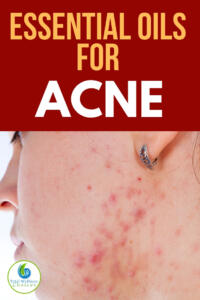 Best Essential oils for acne and pimples