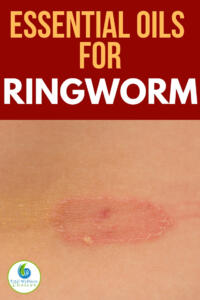 Best essential oils for ringworm