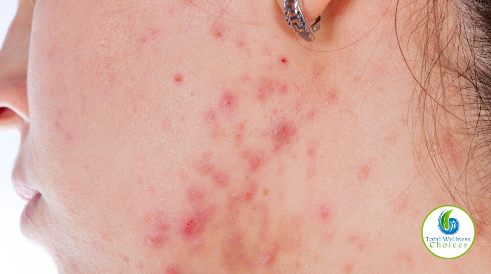 Essential oils for pimples