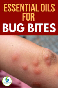 Best essential oils for bug bites