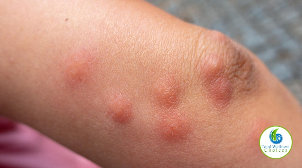 Essential oils for insect bites