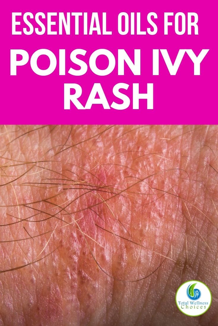 Essential oils for poison ivy rash